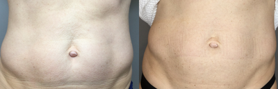45-54 year old woman treated with Skintyte - This patient wanted some tightening of crepey skin on abdomen. We performed skintyte 2 sessions, one month apart. There is no numbing required, no pain, and no down time.