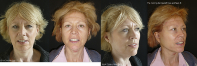 52 year old lady the day after Quicklift under local anaesthesia alone - 52 Year old lady for Quicklift Face and Neck lift. These photos are taken the morning after surgery (18 hours after surgery) performed at the Chilston clinic under local anaesthetic alone. The patient arrived at the clinic at 8am and was back at home by 3pm and slept in her own bed. She will be fit to return to work in a few days with her younger, fresher face. Note the improvement in Neck contour, jawline, jowls and mid-facial volume and relative lack of bruising.

	UPDATE

	Photos 3 and 4 are taken at 6 days post operatively. Most bruising and swelling has now settled.