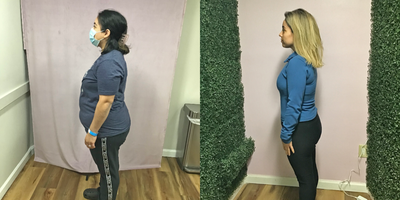 35-44 year old woman treated with Orbera Gastric Balloon, Gastric Balloon - Our patient lost 56 lbs after her Orbera Gastric Balloon.