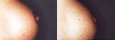 Nipple Reduction - 	Nipple Reduction Before and After