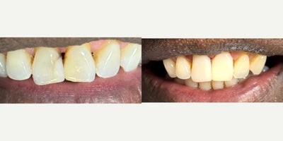 25-34 year old man treated with Dental Bonding in Denver - An amazing smile transformation in just one visit using composite dental bonding to achieve a beautiful, healthy smile.