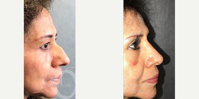 Woman treated with Eyelid Surgery - Woman treated with Eyelid Surgery