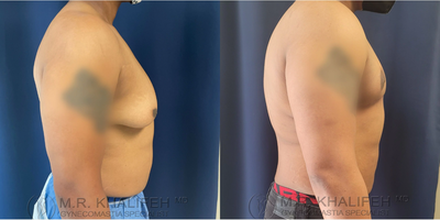 Man treated with Gynecomastia Surgery - Man treated with Gynecomastia Surgery