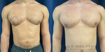 Man treated with Gynecomastia Surgery - Man treated with Gynecomastia Surgery