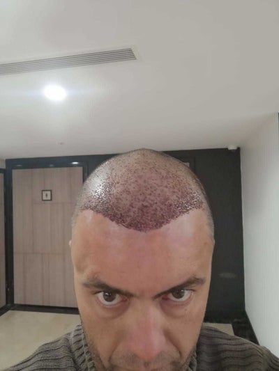Dhi Hair Transplant Operation With Dr Dogan Turan Fuecapilar