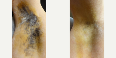 35-44 year old man treated with miraDry - Before each miraDry treatment an iodine solution is applied to the skin and allowed to air-dry. Once dry the area is dusted with cornstarch or potato flour. When sweat reaches the surface of the skin the starch and iodine combine causing a dramatic color change (yellow -&gt; dark blue) allowing sweat production to be actively visualized. These photos demonstrate the level of sweat production at the initial consultation and at the 2 week follow up appointment post 1 treatment with miraDry. Sometimes a 2nd treatment is needed.
