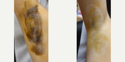 25-34 year old woman treated with miraDry - Before each miraDry treatment an iodine solution is applied to the skin and allowed to air-dry. Once dry the area is dusted with cornstarch or potato flour. When sweat reaches the surface of the skin the starch and iodine combine causing a dramatic color change (yellow -&gt; dark blue) allowing sweat production to be actively visualized. These photos demonstrate the level of sweat production at the initial consultation and at the 2 week follow up appointment post 1 treatment with miraDry. Sometimes a 2nd treatment is needed.
