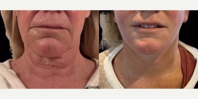 Woman treated with Facelift, Neck Lift - Still, early in the recovery process, this lovely patient is doing well one week after a deep plane facelift and platysmaplasty neck lift.We perform these procedures daily under local anesthesia.