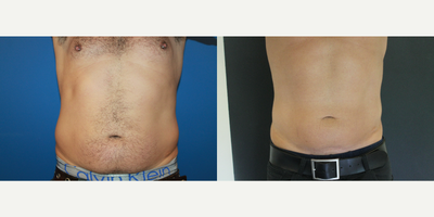 35-44 year old man treated with CoolSculpting - Elite Freeze powered by CoolSculpting