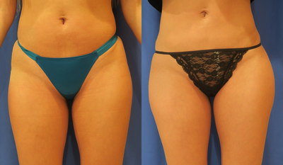 Woman treated with Hip Augmentation - Woman treated with Hip Augmentation using implants