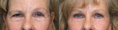 Browlift to Right Brow and Ptosis Repair - Asymmetric brows evened with browlift and CO2 laser with eyelid ptosis repair.
