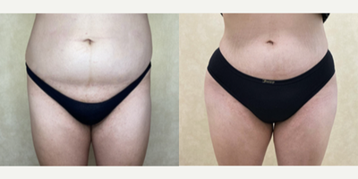 Woman treated with Hip Augmentation - Woman treated with Hip Augmentation using implants