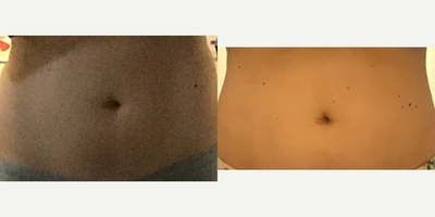 25-34 year old woman treated with Emtone - EmTone to tighten and tone skin