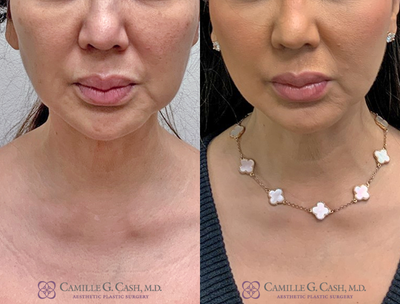 53 year old woman treated with AccuTite and FaceTite - This patient is seen here before and 3 months after treating her lower face and neck with FaceTite and AccuTite, performed in the comfort of my office.