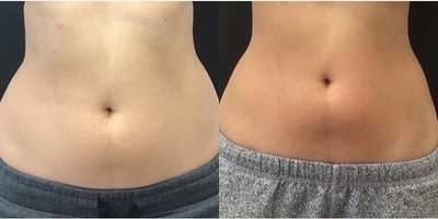 Woman treated with BodyFX - Woman treated with BodyFX