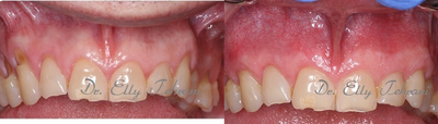 45-54 year old man adding tissue using Pinhole Surgical Technique - Male patient with severe recession on the upper front teeth. Pinhole Surgical Technique was used to cover the exposed roots. The after photo shows the results 2 months post-op.