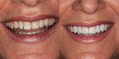 Woman treated with Da Vinci Veneers - Patient had square, chipped, discolored, rotated and poorly shaped teeth. Teeth restored with DaVinci veneers and 3/4 porcelain crowns.