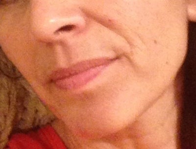 Chipmunk Cheeks And Dead Hollowed Eyes From Botox On Crows Feet