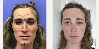 Patient treated with Facial Feminization Surgery, Transgender Facial Feminization Surgery - 25 to 34 year-old female patient is 1 month post-op from Facial Feminization surgery. Her procedures included: Forehead Lift, Hairline Lowering, Supra Orbital Bone Reduction and Contouring, Septorhinoplasty (closed) with Cartilage Grafts, Chin Reduction and Contour, Intranasal Lip Lift, Fascia to Lips, Thyroid Cartilage Shave and 300 Micrografts to the Fronto Temporal Recessions.