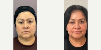 Woman treated with Dermal Fillers - Woman treated with Dermal Fillers