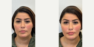 Woman treated with Dermal Fillers - Woman treated with Dermal Fillers