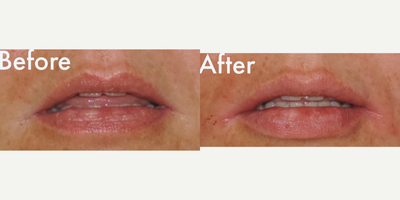 Woman treated with Restylane Silk - Woman treated with Restylane Silk