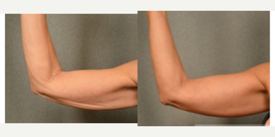 45-54 year old woman treated with Arm Skin Tightening with Bodytite - 45-54 year old woman treated with Arm&nbsp;Skin Tightening with Bodytite