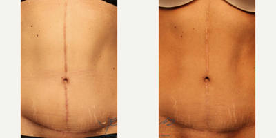 44 year old woman treated with Morpheus8 - A series of 3 Morpheus8 treatments spaced 4-6 weeks apart were recommended to her and carried out. These photos were taken 12 weeks after her final treatment. The scars have become the color of her skin and are much flatter, some parts are unnoticeable! The top portion of her scar is still slightly raised but will continue to improve with more time.