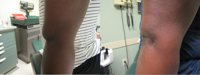 Woman treated with BodyFX - K.W. Body FX mini elbows