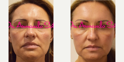 45- 54 year old woman treated with Fractional Laser - This 50 year old woman wished to improve a complexion that had become dull and irregular through aging and sun damage. Living up to its name, a HALO procedure performed for her at Aesthetic Enhancements in Orlando gave her back a glowing, healthy and smooth appearance.