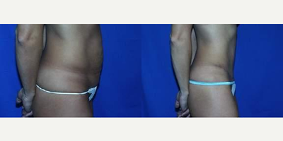 35-44 year old woman treated with Tummy Tuck - 35-44 year old woman treated with Tummy Tuck