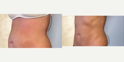 35-44 year old woman treated with Semaglutide, Evolve - Treated by Tracy Kwan, PA and Alyssa G, laser tech