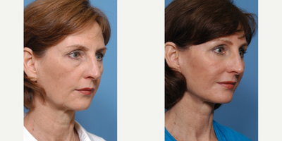 55-64 year old woman treated with Facelift, upper and lower eyelid surgery ans laser resurfacing. - This woman consulted with Dr. Holden because she felt she looked tired and older than she felt. Dr. Holden performed her facelift, upper and lower eyelid surgery and full face laser resurfacing.