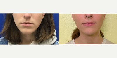 Patient treated with Adam's Apple Reduction - Thyroid Cartilage Shave - 18 to 24 year-old female patient is 11 months post-op from Adam's Apple Reduction/Thyroid Cartilage Shave surgery.