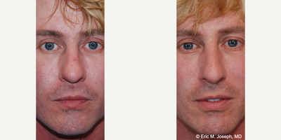 35-44 year old man treated with Silikon 1000, Nonsurgical Nose Job - Our 42 year old handsome patient traveled far to see us, mainly for our expertise with acne scarring. He had several other modalities of treatment, and he was persistently dissatisfied with indentations, and broad based scars involving both of his cheeks and temples. He also requested a Silikon-1000 treatment to camouflage the profile bump on his nose. He was in town and visited us for post-procedure photography. You can see smoother cheeks, and improvement in his right cheek deep indentation. A second treatment to his nose was offered, but he was happy with his natural looking improvement.