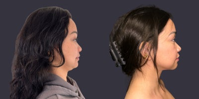 25-34 year old woman treated with Chin Liposuction, Liposuction - 34 year old woman, 5 tall, 112 pounds, no children yet. Submental liposuction to reduce double chin and define jawline.