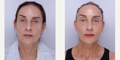 55-64 year old woman treated with Facelift, Neck Lift, Brow Lift, Facial Fat Transfer, CO2 Laser - 59 year old patient is 2 months post op: Facelift, Neck lift, Temporal Brow lift, facial fat transfer and co2 laser with Dr. Madnani.