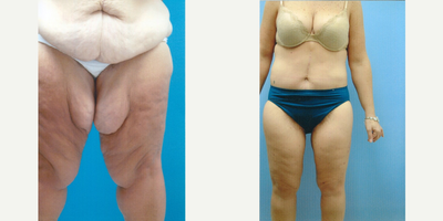 34 year old woman treated with Thigh Lift - 34 year old female after massive weight loss underwent thigh lift