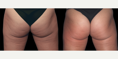 Woman treated with Emtone - Photo provided courtesy of Emtone, performed by Marc J. Salzman, MD, FACS.