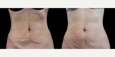 Woman treated with Emtone - Photo provided courtesy of Emtone, performed by Klaus Fritz, MD