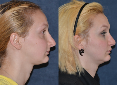 18-24 year old woman treated with Revision Rhinoplasty - patient with previous rhinoplasty by another surgeon left with dorsal hump and tip irregularities.
