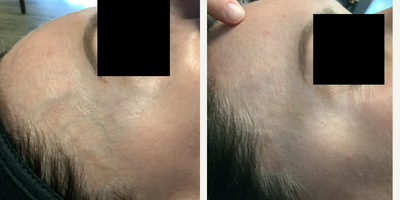 Woman treated with Asclera - Female patient 2 weeks post-op one sessions of Face Sclerotherapy
