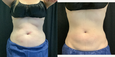 Woman treated with Cryolipolysis - Pre-Treatment vs Post-Treatment CoolSCulpting Elite. This patient had 2 rounds of CoolSculpting, 4 weeks apart.
