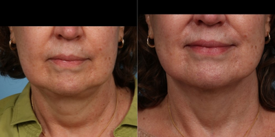 55-64 year old woman treated with PrecisionTx - Our 62 year old 7 month post operative patient couldnt be happier after her Precision Tx Laser Lift of her neck and jaw line and Fraxel Repair of neck with PRP.She didnt want a facelift.  Results can last 3 to 5 years.  At that point, many patients will opt for a facelift, my preferred approach is a deep plane facelift, but others will undergo a 2nd Laser Lift