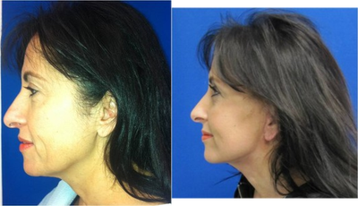 Facelift - 
	Facelift
