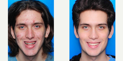 25-34 year old man treated with Orthognathic Surgery - Jaw surgery