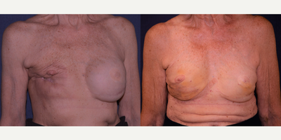 Woman treated with Breast Fat Transfer - Woman treated with Breast Fat Transfer