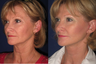 Mini Lift - This patient underwent Mini Facelift for correction of mild facial aging, and facial fat transfer to restore facial volume.