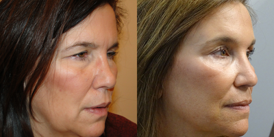 55-64 year old woman treated with Forehead Lift - Treated with Bilateral Endoscopic Forehead Lift.