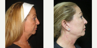 55-64 year old woman treated with Facelift - Patient underwent full face and neck lift with fat grafting.